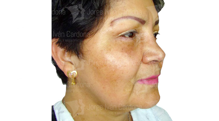 cirugia facial bichectomia jorge Cardona Maxilofacial