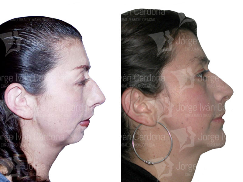 cirugia facial mentoplastia jorge cardona maxilofacial
