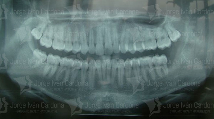 cirugia oral jorge cardona maxilofacial