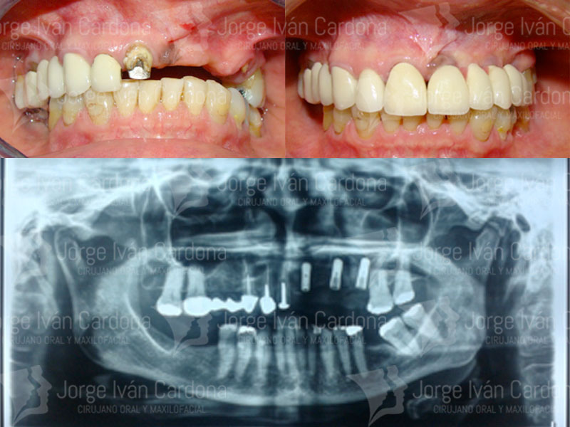 implante dental jorge cardona maxilofacial