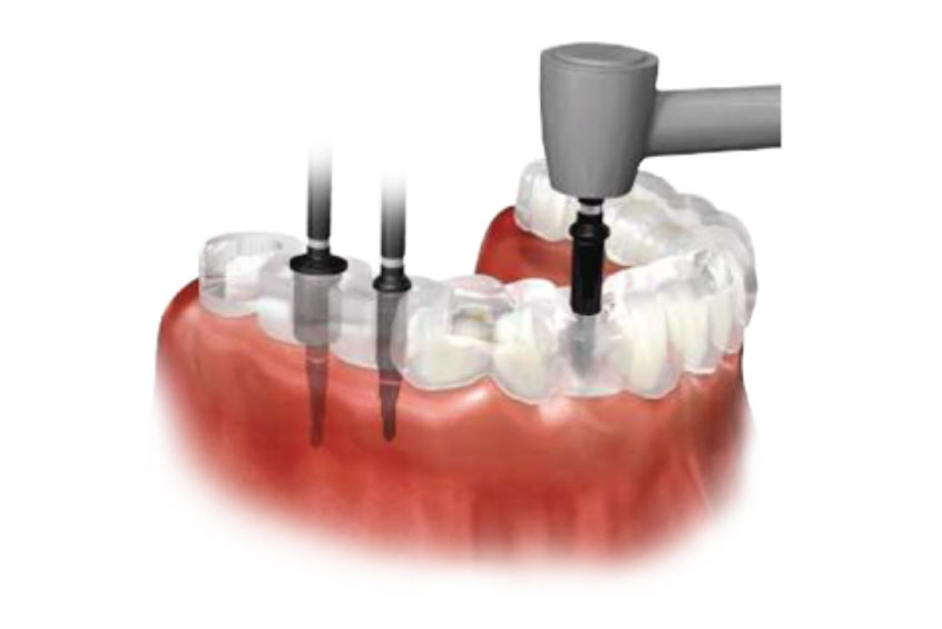 implantes dentales Jorge Iván Cardona Maxilofacial