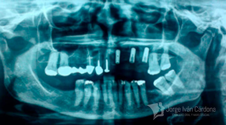 implantes dentales jorge cardona maxilofacial