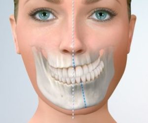 alt=Asimetría Facial: se produce cuando el rostro no es simétrico o equilibrado, por ejemplo, un lado de la mandíbula o el maxilar más desarrollado que el lado contrario. La cara puede verse descentrada, los dientes superiores o inferiores pueden estar desplazados hacia un lado, generando incomodidad en la mordida y la masticación. Requiere una Cirugía Ortognatica