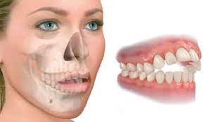 alt=Mordida abierta: se presenta cuando no hay contacto entre los dientes superiores e inferiores. Si todos o algunos dientes no chocan entre si, se hace difícil no solo la masticación sino el selle de los labios cuando la cara se encuentra en reposo