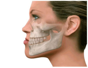 alt=Prognatismo Mandibular: cuando se presenta aumento desmedido del crecimiento de la mandíbula. Requiere una Cirugía Ortognatica