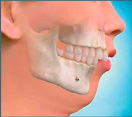 alt=Retrognatismo Mandibular: la mandíbula es muy pequeña o se encuentra posicionada hacia atrás. Requiere una Cirugía Ortognatica